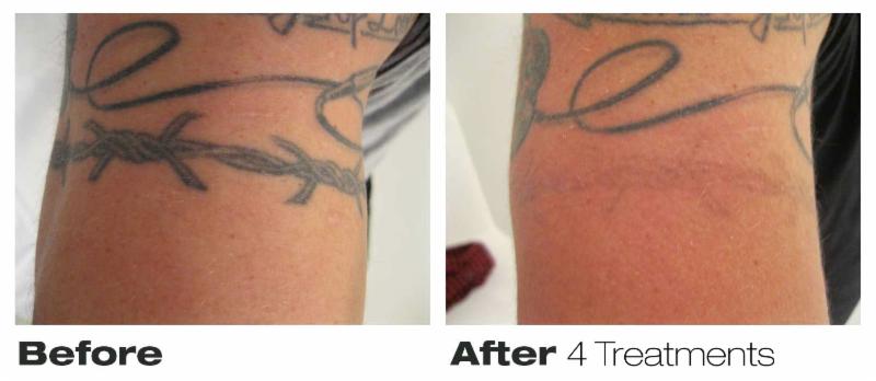 Precision Laser Tattoo Removal - Opening Hours - 76 ...